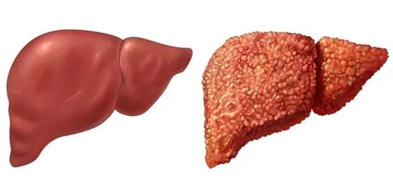 Hiểm họa và xu hướng phòng chống các bệnh về gan